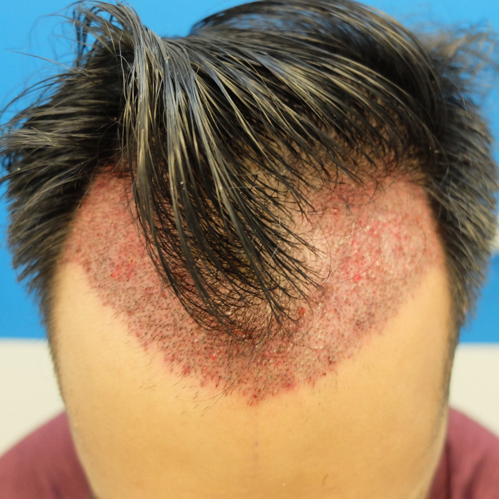 Hair Transplant What To Expect Post The PPocedure 